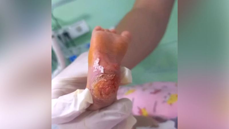 Новорождённому сожгли пятку в роддоме Кызылорды