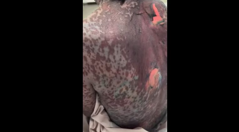 Лечение народными методами: жительница Шымкента попала в больницу с обширным поражением кожи