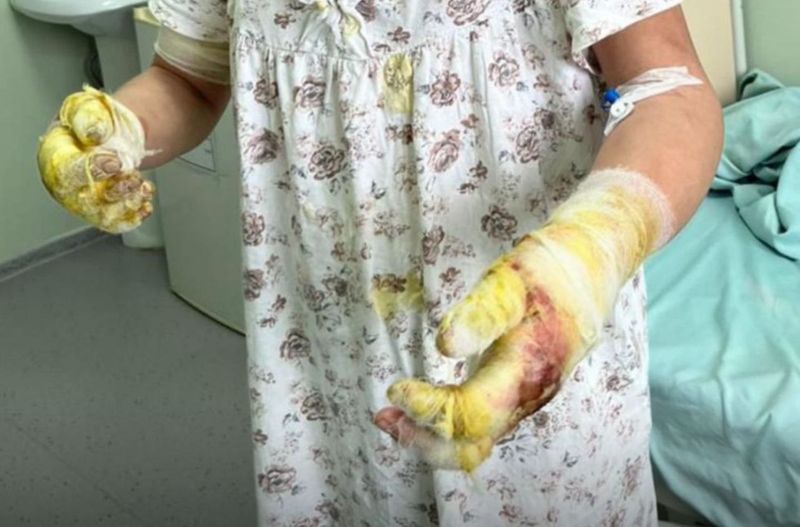 Подожженная сожителем женщина ранее подвергалась насилию в Алматинской области