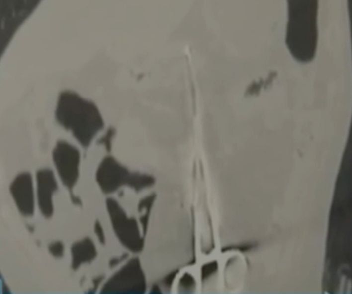 Забыли достать зажим из живота: житель Шахтинска пытается отсудить достойную компенсацию