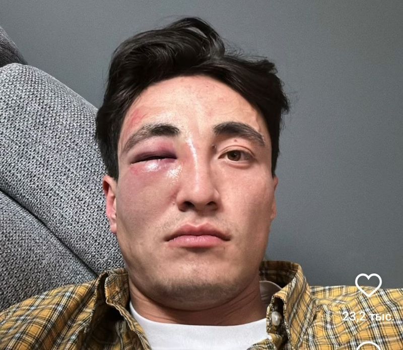 Заступился за девушку: травму глаза получил участник Олимпийских игр в Париже