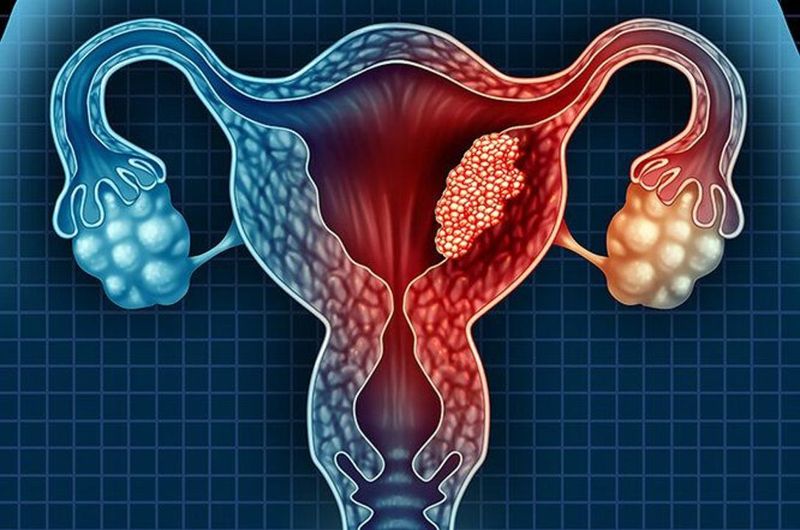 Опухоль весом 15 килограммов удалили онкологи в Алматы