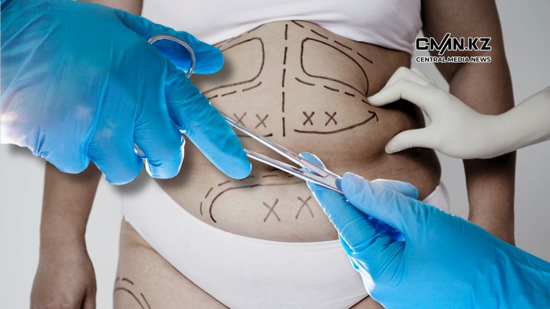 В частной клинике Алматы умерла женщина после липосакции живота