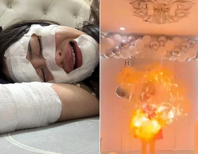 День рождения с обожженным лицом: вьетнамка пострадала при взрыве шариков
