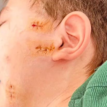 Напал в лифте: часть лица пострадавшего мальчика остается неподвижной