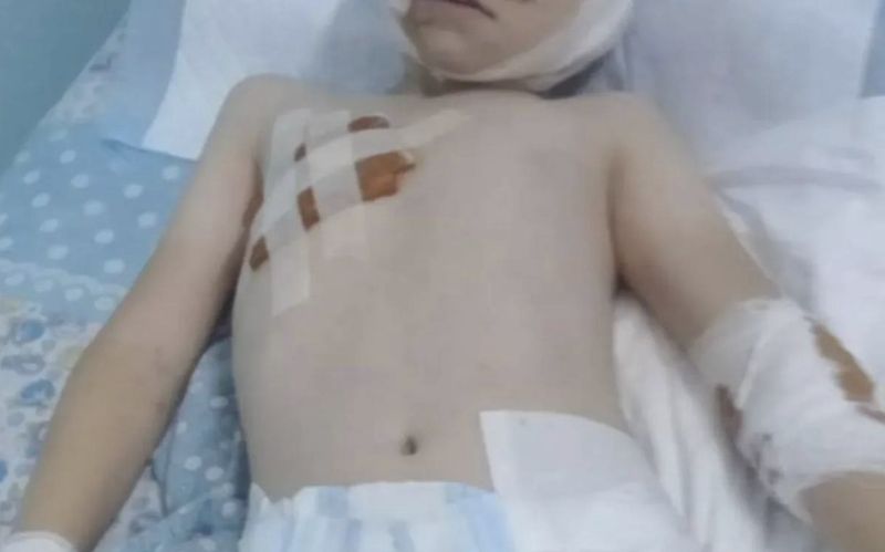 Состояние мальчика, покусанного собаками под Алматы, остается стабильно тяжелым