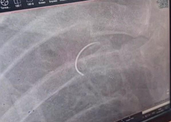 Медицинскую иглу забыли медики у карагандинца в животе во время операции