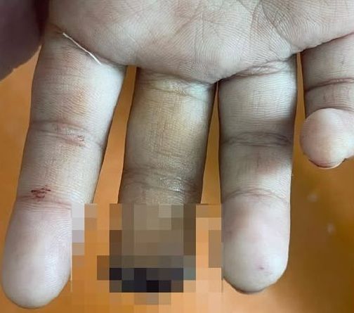 Школьнице оторвало часть пальца на уличном тренажере в Атырау