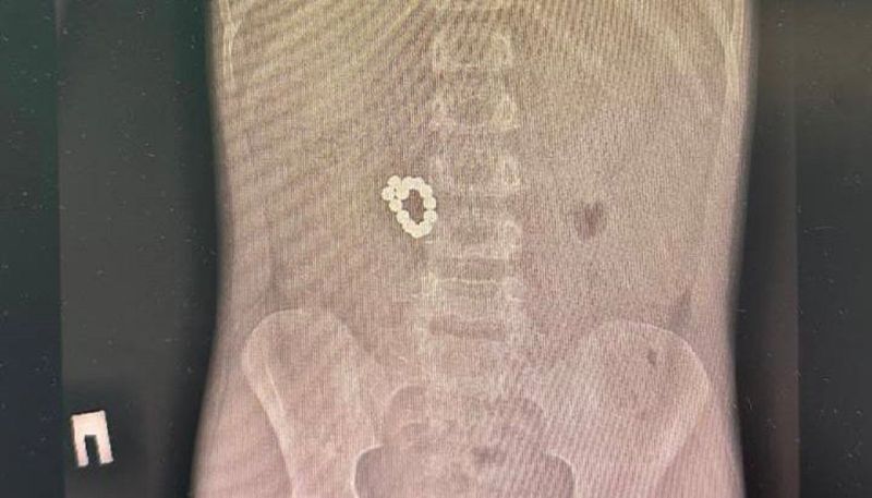 13 магнитов в кишечнике: двое детей поступили в больницу Алматы в тяжёлом состоянии