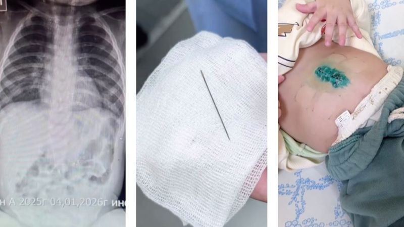 Швейную иглу достали из печени восьмимесячного малыша в Туркестанской области