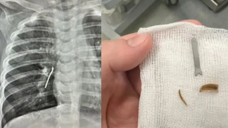 Опасные предметы извлекли из лёгких годовалого малыша в Актау